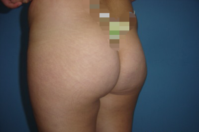 ANTES